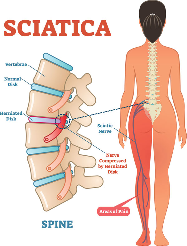 Is Inflammation Causing Your Sciatica?