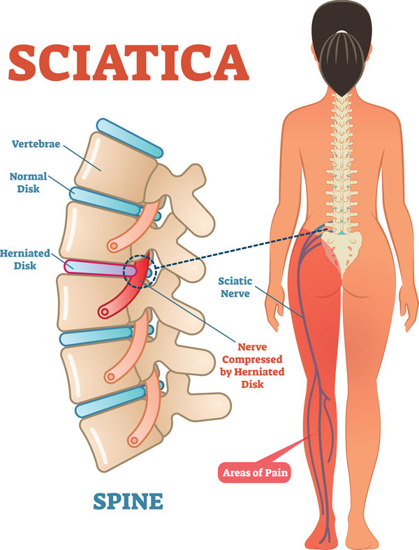 https://www.commonschiropractic.com/img/site_assets/sciatica-treatment.jpg